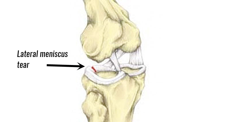 膝关节外侧半月板撕裂