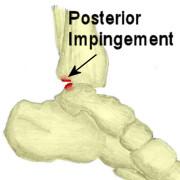 Ankle Impingement - Symptoms, Causes, Treatment & Rehabilitation - 金宝搏 ...